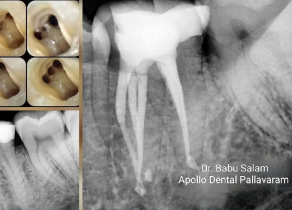 Root Canal